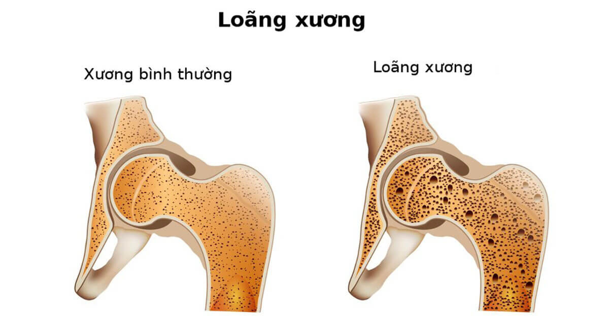 bệnh loãng xương