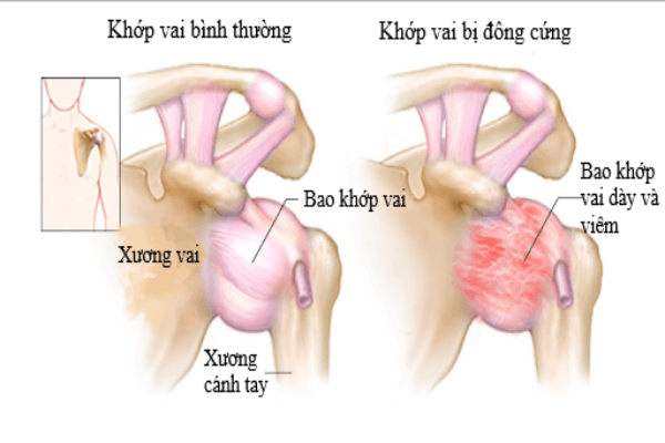 Viêm quanh khớp vai thể đông cứng