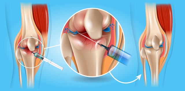 các phương pháp điều trị thoái hóa khớp gối