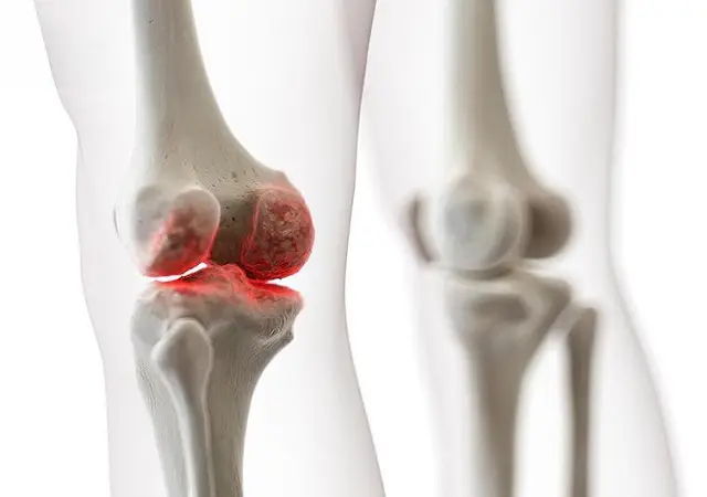 Khớp gối bị khô khô khớp gối uống thuốc gì