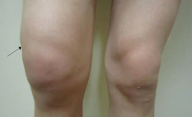 biến chứng tràn dịch khớp gối